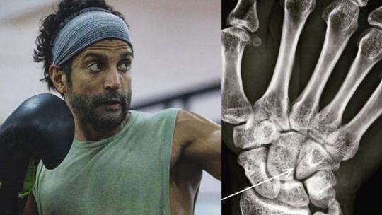 Farhan Suffers Hairline Fracture While Shooting For Toofan