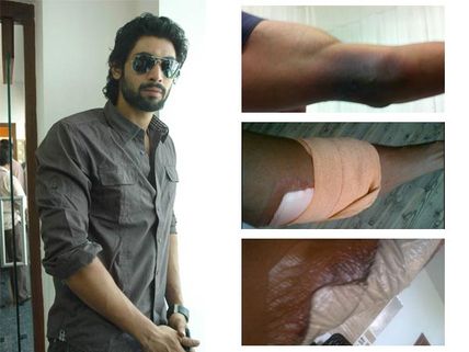 Rana Daggubati posts photos of his injured arm