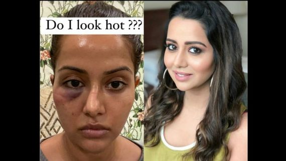 Raiza Wilson Shares Pictures Days After Her Facial Treatment Went Wrong; Asks If She Looks Hot