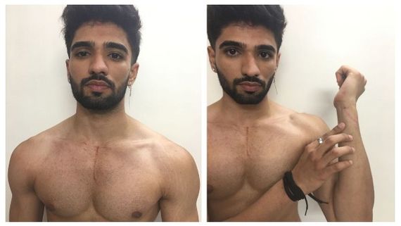 Bigg Boss OTT: Zeeshan Khan Shares Injury Photos After Exit; Fans Call His Eviction An Unfair One, See Tweets!