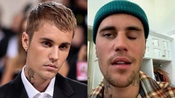 Justin Bieber Reveals The Right Side Of His Face Is Paralysed After Virus Attack 