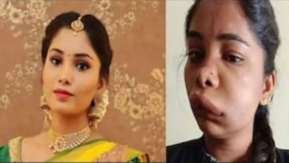 Actress Swathi Sathish Looks Unrecognisable After Botched-Up Root Canal, Pics Of Her Swollen Face Go Viral