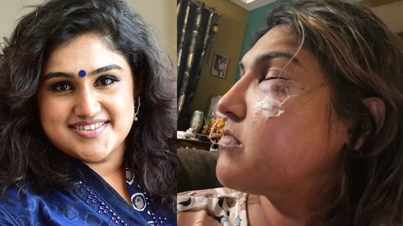 Bigg Boss Tamil 7: Vanitha Alleges Assault By Pradeep Antony Supporter: Shares Shocking Pic On Social Media