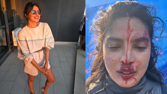 Priyanka Chopra’s Injured Face & Hands Pics Leave Fans Concerned About Her Well Being; Here’s A Fact Check 