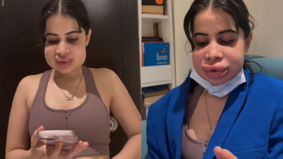 Uorfi Javed Drops NEW Video After Dissolving Lip Fillers; Cracks An Epic Joke On Her Swollen Face