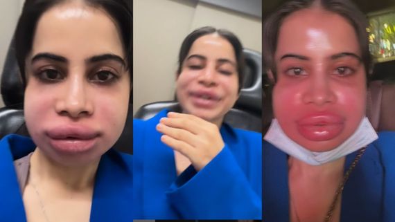 Uorfi Javed UNSEEN Pics: The Traitors' Winner Gets FILLERS Dissolved, 'Buri Halat Ho Gayi Thi...'