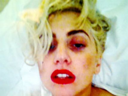 ಪಾಪ್ ತಾರೆ ಲೇಡಿ ಗಾಗಾ ಮುಖಕ್ಕೆ ಬಲವಾದ ಪೆಟ್ಟು