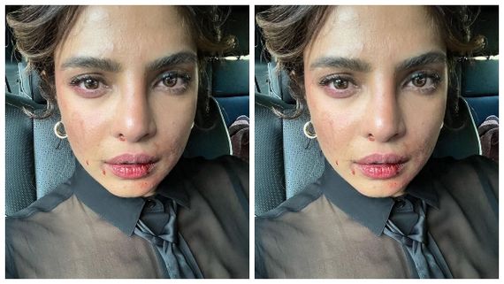  ಪ್ರಿಯಾಂಕಾ ಚೋಪ್ರಾ ಮುಖಕ್ಕೆ ಅಂಥದ್ದೇನಾಯ್ತು? ಪೋಟೊ ನೋಡಿ ಫ್ಯಾನ್ಸ್ ಏನಂದ್ರು? 