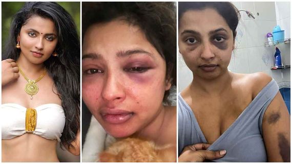 ನಟಿಯ ಮೇಲೆ ಮಾಜಿ ಪ್ರಿಯಕರನಿಂದ ಮಾರಣಾಂತಿಕ ಹಲ್ಲೆ: ಬೆಂಗಳೂರಿನಲ್ಲೂ ದಾಖಲಾಗಿತ್ತು ಕೇಸ್