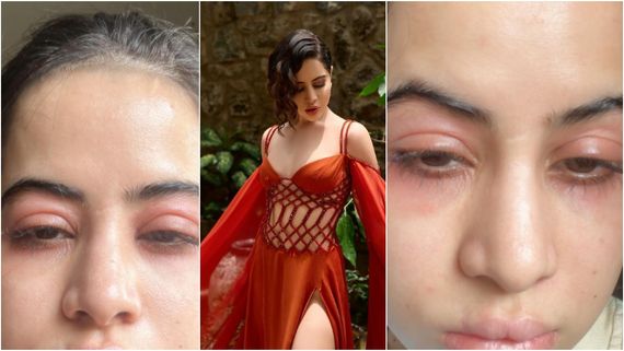 ಬೆಳಗಾದರೆ ಉರ್ಫಿ ಜಾವೇದ್ ಮುಖ ಹೀಗೆ ಊದಿಕೊಳ್ಳುತ್ತೆ; ಫೋಟೊ ಶೇರ್ ಮಾಡಿ ಆರೋಗ್ಯ ಸಮಸ್ಯೆ ಹೇಳಿಕೊಂಡ ಉರ್ಫಿ!?       