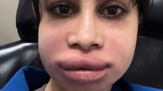 ಲಿಪ್ ಸರ್ಜರಿ ಸೈಡ್ ಎಫೆಕ್ಟ್, ಊದಿಕೊಂಡ ಖ್ಯಾತ ನಟಿಯ ಮುಖ, ಶಾಕ್ ಆದ ಫ್ಯಾನ್ಸ್ 