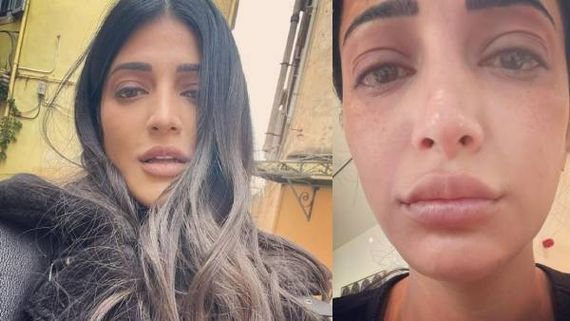 வீங்கிய உதடு..ஆளே அடையாளம் தெரியாமல் மாறிப்போன ஸ்ருதிஹாசன்.. என்ன ஆச்சு?பதறிய ரசிகர்கள்!