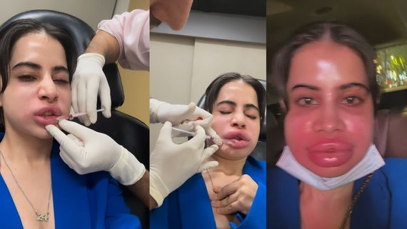 உதட்டுல ஊசி போட்ட உடனே வீங்கிய முகம்.. உர்ஃபி ஜாவேத்துக்கு அப்படி என்ன ஆச்சு?.. வைரலாகும் வீடியோ!