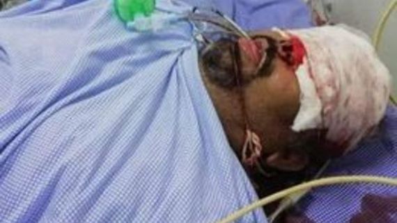  కత్తి మహేష్ కారుకు యాక్సిడెంట్... కంటికి తీవ్ర గాయాలు, ఆపరేషన్ కూడా!   