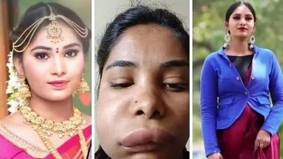 వికటించిన సర్జరీ.. అందమైన హీరోయిన్ పరిస్థితి దారుణంగా.. ముఖం గుర్తుపట్టలేనంత భయంకరంగా!