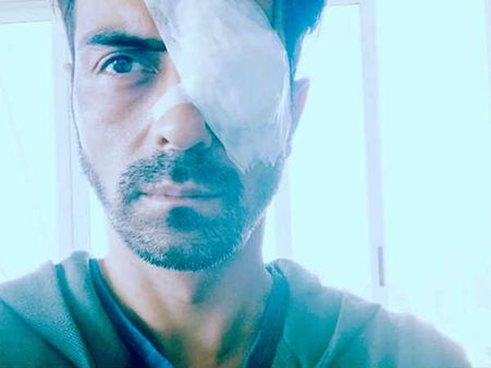 अर्जुन रामपाल की आंख पर लगी चोट..पोस्ट की तस्वीर