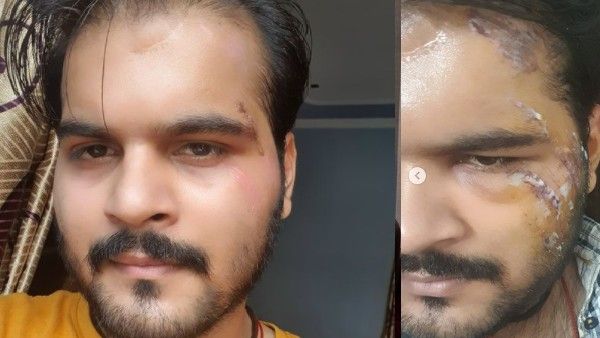 भोजपुरी एक्टर अरविंद अकेला कल्लू हुए एक्सीडेंट का शिकार, खून से सनी तस्वीरें की शेयर- 'नया जीवन मिला है'