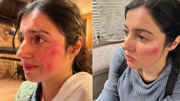 Divya Khosla Kumar फिल्म की शूटिंग के दौरान हुईं बुरी तरह से घायल, ऐसे बिगड़ा चेहरा, Photo