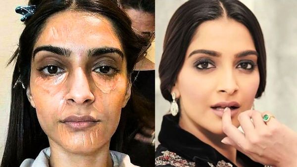 Dark Circles की वजह से आपकी भी खूबसूरती गई है दब, फॉलो करें सोनम कपूर की ये टिप्स, 2 दिन में दिखेगा रिजल्ट