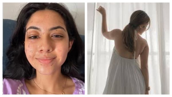 सूजी आंखें, मुंह पर चोटों के निशान.. शूट करते हुए बुरी तरह जली एक्ट्रेस, हालत देख सकपकाए लोग