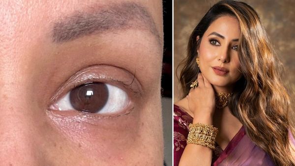 Hina Khan की हालत हुई बदतर? पलकों पर बचा है सिर्फ एक बाल, Photo देख दुआएं कर रहे हैं फैंस!