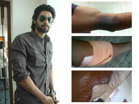 Rana Daggubati posts photos of his injured arm