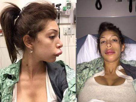 Farrah Abraham Now Has Botched Lips, Shares Pics