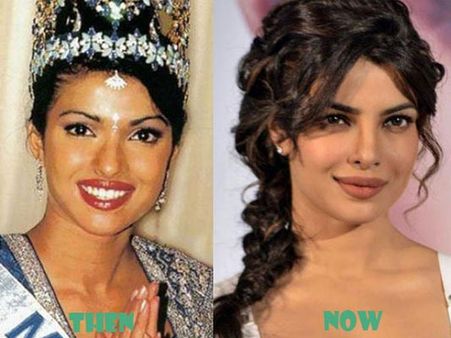 Is This Her Natural Nose? For The FIRST TIME Priyanka Chopra Talks About Her PLASTIC SURGERY!