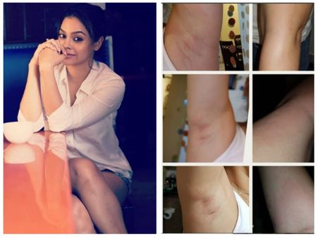 The Kapil Sharma Show’s Sumona Chakravarti Sustains Bruises; Slams Online Service Provider!