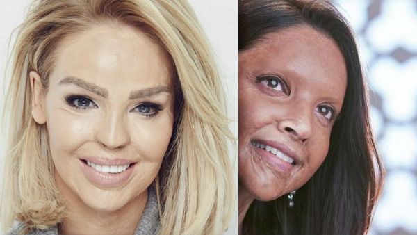 Deepika Padukone’s Chhapaak Trailer ‘Took My Breath Away,’ Tweets Acid Attack Survivor Katie Piper
