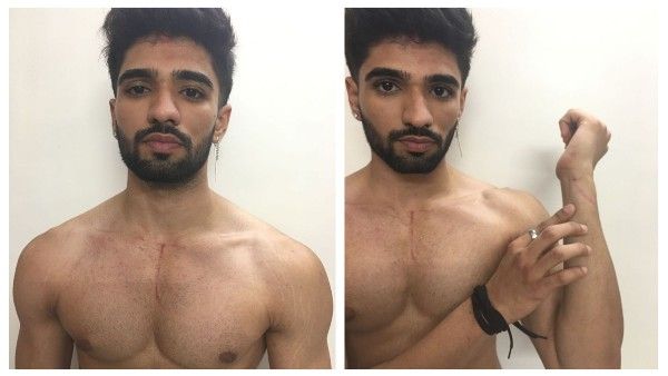 Bigg Boss OTT: Zeeshan Khan Shares Injury Photos After Exit; Fans Call His Eviction An Unfair One, See Tweets!