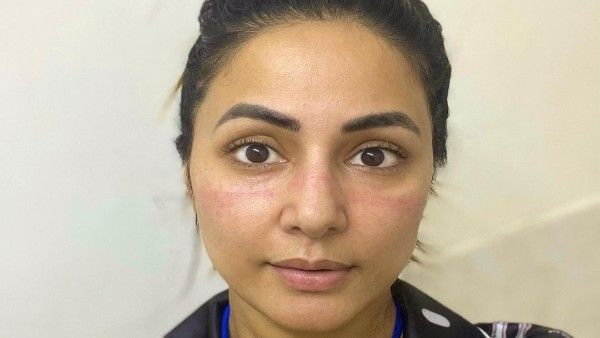 Hina Khan’s Family Tests Positive For COVID-19, Actress Shares Pics Of Marks On Her Face From Wearing Masks