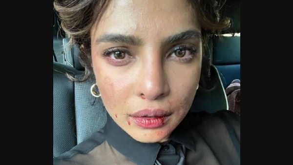 Priyanka Chopra's Bruised Face Photo From Citadel Sets Leaves Fans Concerned