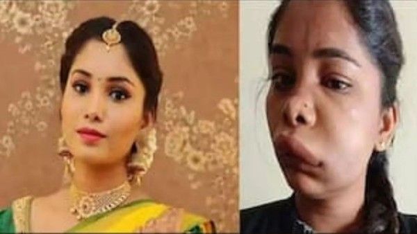 Actress Swathi Sathish Looks Unrecognisable After Botched-Up Root Canal, Pics Of Her Swollen Face Go Viral