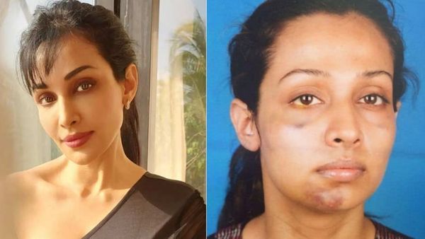 Gandi Baat Actress Flora Saini Recalls Horrific Domestic Abuse By Ex-Partner, Says, 'Left With Fractured Jaw'