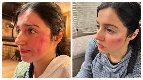 Divya Khosla Kumar Gets Badly Injured On Sets, Suffers Bruises On Face: Need All Your...