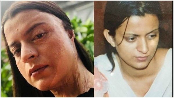 ತನ್ನ ಮೇಲಾದ ಆಸಿಡ್ ದಾಳಿಯ ದಾರುಣ ಕಥೆ ಬಿಚ್ಚಿಟ್ಟ ನಟಿ ಕಂಗನಾ ಸಹೋದರಿ ರಂಗೋಲಿ