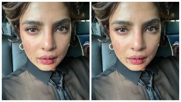 ಪ್ರಿಯಾಂಕಾ ಚೋಪ್ರಾ ಮುಖಕ್ಕೆ ಅಂಥದ್ದೇನಾಯ್ತು? ಪೋಟೊ ನೋಡಿ ಫ್ಯಾನ್ಸ್ ಏನಂದ್ರು?