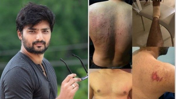 ಶೂಟಿಂಗ್ ವೇಳೆ ಗಾಯಗೊಂಡ ನಿರೂಪ್ ಭಂಡಾರಿ, ಫೋಟೊ ಹಂಚಿಕೊಂಡ ಅನೂಪ್ ಭಂಡಾರಿ!