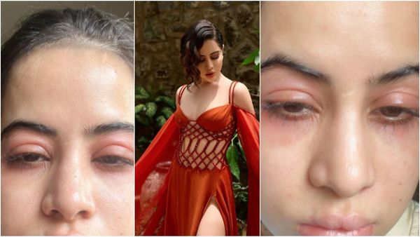 ಬೆಳಗಾದರೆ ಉರ್ಫಿ ಜಾವೇದ್ ಮುಖ ಹೀಗೆ ಊದಿಕೊಳ್ಳುತ್ತೆ; ಫೋಟೊ ಶೇರ್ ಮಾಡಿ ಆರೋಗ್ಯ ಸಮಸ್ಯೆ ಹೇಳಿಕೊಂಡ ಉರ್ಫಿ!?