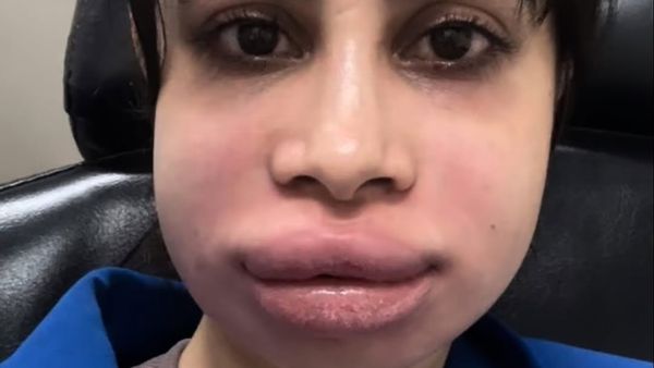 ಲಿಪ್ ಸರ್ಜರಿ ಸೈಡ್ ಎಫೆಕ್ಟ್, ಊದಿಕೊಂಡ ಖ್ಯಾತ ನಟಿಯ ಮುಖ, ಶಾಕ್ ಆದ ಫ್ಯಾನ್ಸ್