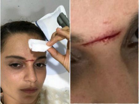 ഝാന്‍സി റാണിയാവാനുള്ള കങ്കണയുടെ ശ്രമം പാളി പോയി, കിട്ടിയത് ഒന്നൊന്നര മുറിവ്! അതും ഇങ്ങനെ!!!