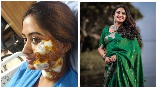 ഏറ്റവും വെല്ലുവിളി നിറഞ്ഞ രംഗം അതായിരുന്നു, പൊള്ളിയടർന്ന മുഖത്തെ കുറിച്ച് സ്വാതി നിത്യാനന്ദ്