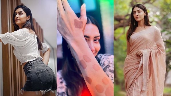 നിങ്ങള്‍ രണ്ടു പേരുമില്ലാതെ ഈ ഘട്ടം ചിന്തിക്കാന്‍ വയ്യ; വിറ്റിലിഗോ ദിനത്തില്‍ രോഗാവസ്ഥ തുറന്നുകാട്ടി മംമ്ത