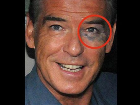 வீங்கிய.. கறுப்பு நீல நிறக் கண்ணோடு காரில் வலம் வந்த பியர்ஸ் பிரோஸ்னன்