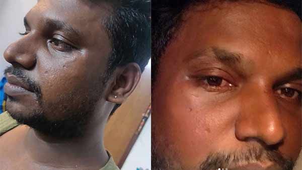 சூரியாதேவி ரவுடிகளுடன் வந்து தாக்கியது ஏன்? காயம் அடைந்த நாஞ்சில் விஜயன் போலீசில் புகார்!