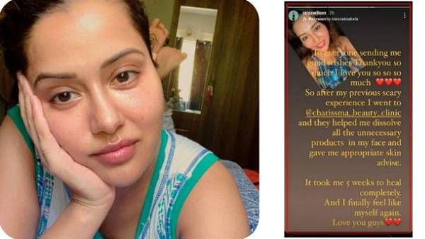 மீண்டும் புதிய ஸ்கின் கிளினிக் முகத்தில் வீக்கம் வடிந்தது இப்படிதான் மனம் திறந்த நடிகை ரைஸா வில்சன்!