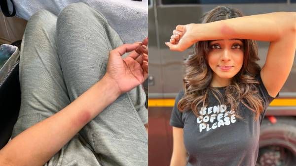 ஆக்ஷன் காட்சியில் நடித்த போது கையில் காயம்.. போட்டோ ஷேர் செய்த மாஸ்டர் பட நடிகை!