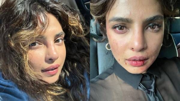 பிரியங்கா சோப்ரா விபத்தில் சிக்கினாரா?.. ரத்த காயத்துடன் வெளியான போட்டோ.. பதறிய ரசிகர்கள்!