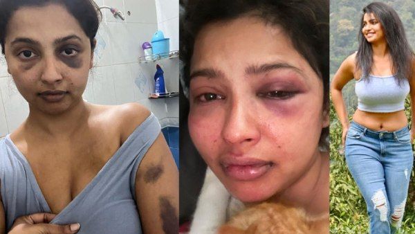 படுமோசமாக தாக்கிய முன்னாள் காதலன்.. போட்டோவை பகிர்ந்து கண்கலங்கிய பிரபல நடிகை!